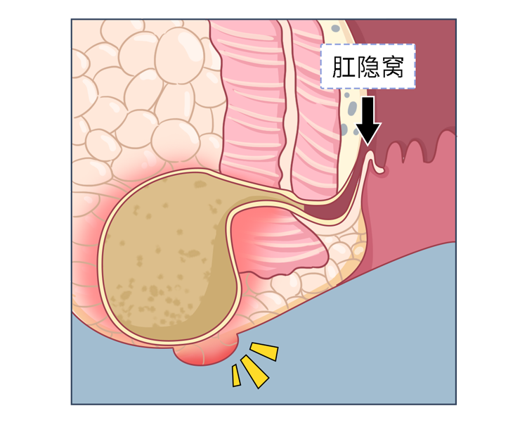 这是两种完全不同的疾病 痔疮 是肛门内的肛垫 因血液回流不畅而肿胀