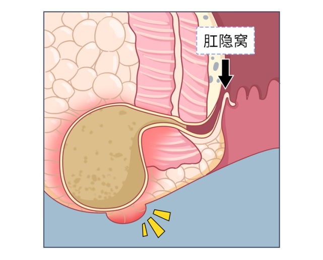 "肛瘘手术,到底有