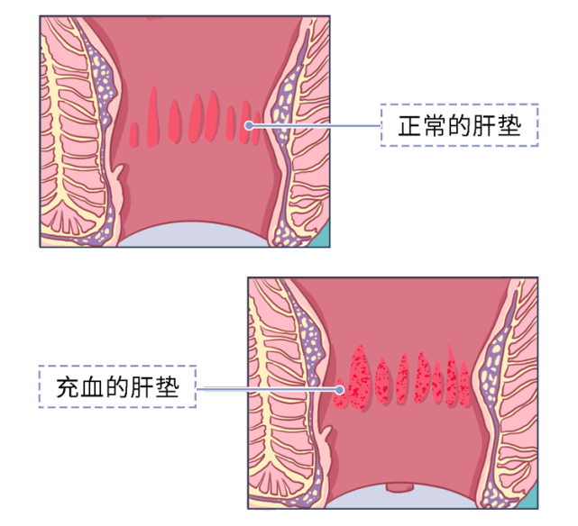 "肛瘘手术,到底有