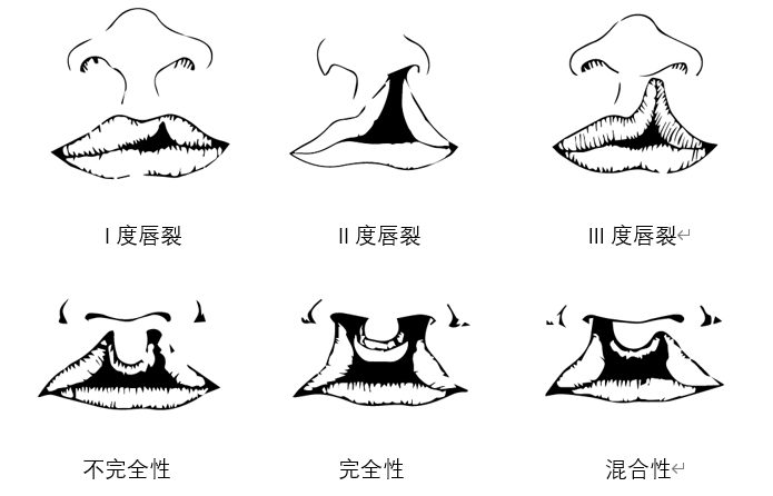 (图片出自百度搜索"唇裂分类") (图片出自百度搜索"腭裂分类") 05