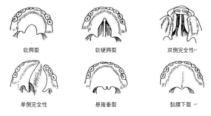 科普小课堂—唇腭裂的形成及种类_腾讯新闻