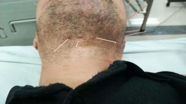 针灸治疗中风这些知识你该知道
