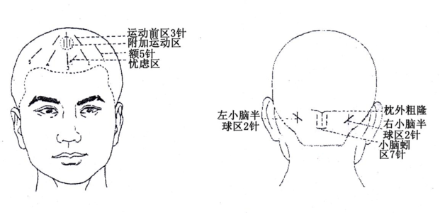 3.中风后吞咽困难和言语障碍针灸治疗区别?