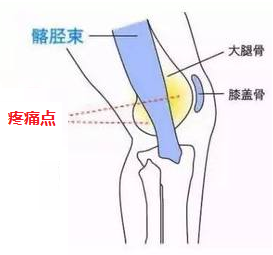 跑步后膝盖疼痛,警惕"跑步膝"