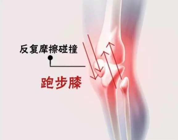 跑步后膝盖疼痛,警惕"跑步膝"