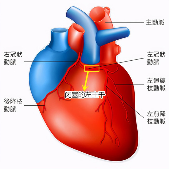 心脏三个大血管,52岁男子两个血管都丢失,手术台上心脏停跳!