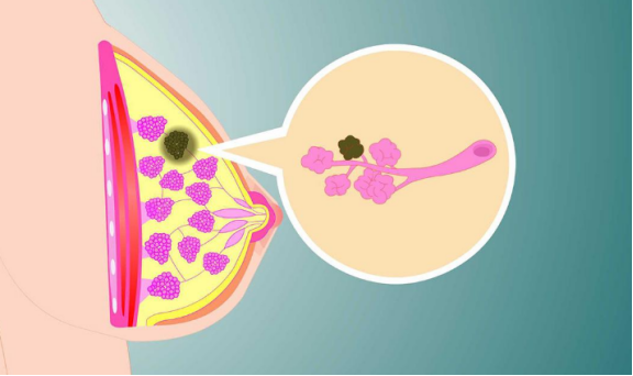 提醒:3类人或是乳腺结节"候选人",希望你不在列