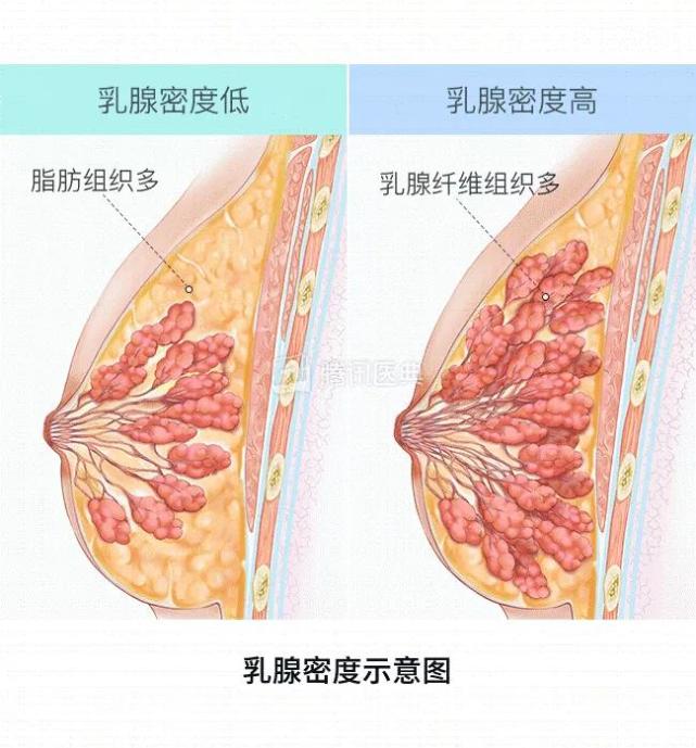 乳腺腺体的多少和密度,才是乳腺癌的高危因素之一.