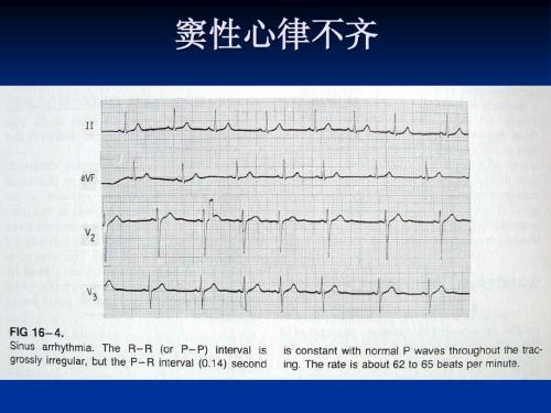 窦性心律不齐是不是心脏,需要治疗吗?