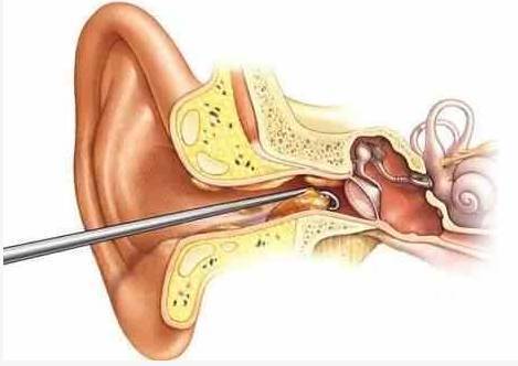 防止异物进入, 还可以有效地预防外耳道炎, 耳道湿疹, 耳道真菌等