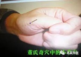 中风后遗症董针常用取穴方法