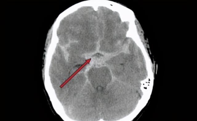 若身体出现这些表现,及时去医院做脑部ct,预防脑梗"找
