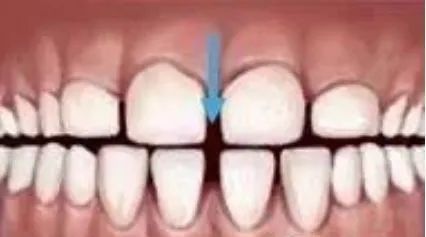 8,门牙间隙过大 两颗门牙间缝隙过大,影响美观 并且会对口腔卫生产生