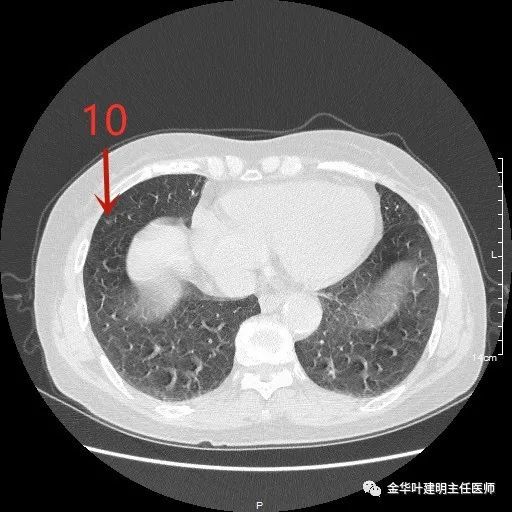 病例分享(20212.28):一例多发磨玻璃结节的诸多反思!