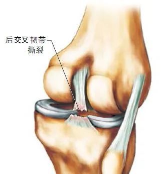 跑者常见的膝关节损伤指南