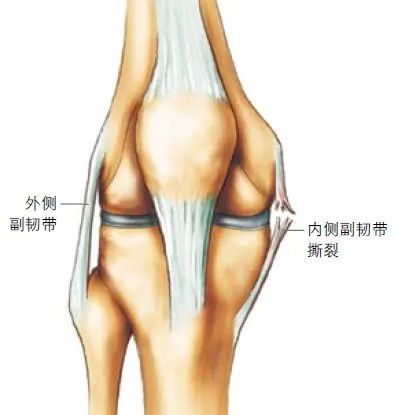 内/外侧副韧带可以限制膝关节内外侧过度活动.