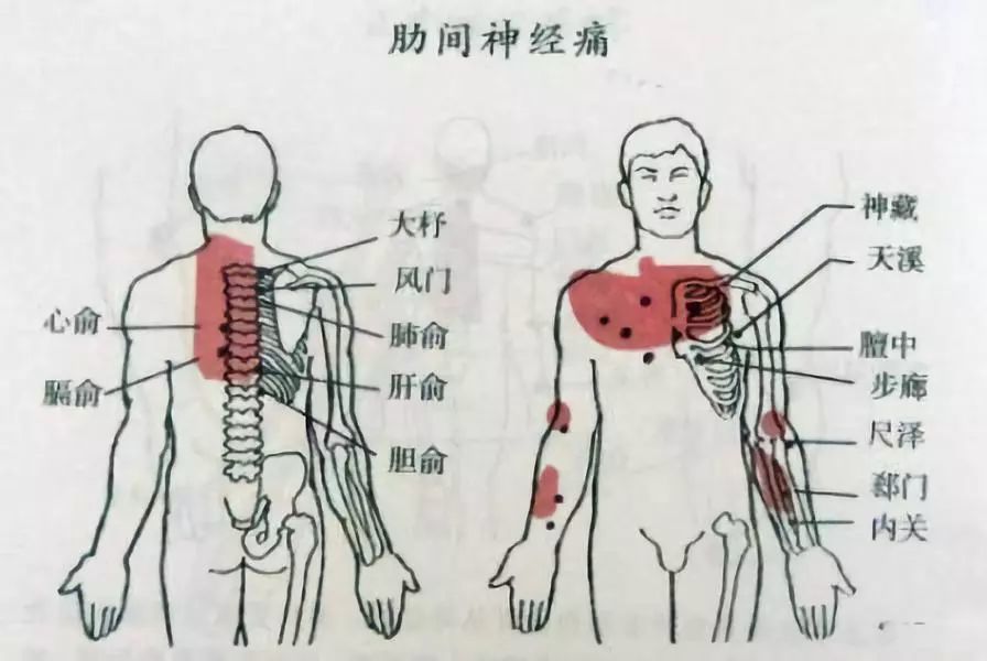 发病时,可见疼痛由后向前,沿相应的肋间隙放射呈半环形;疼痛呈刺痛或