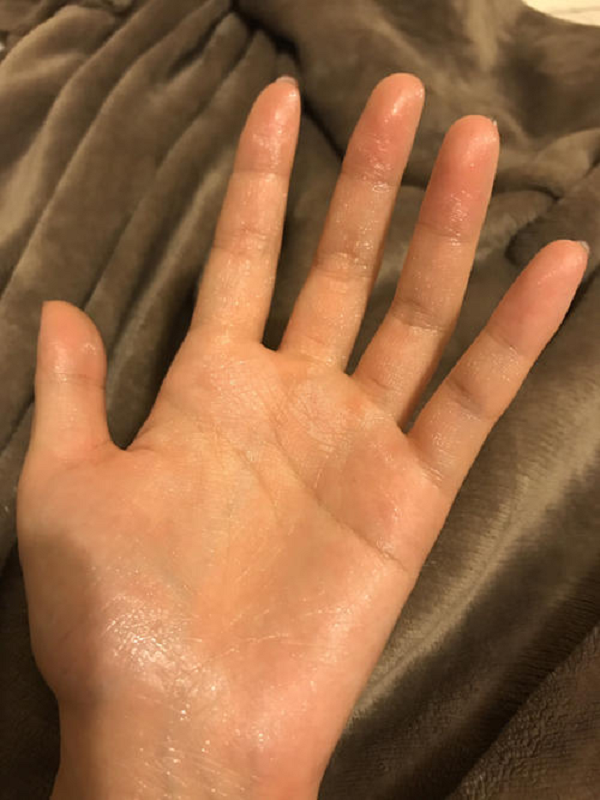 手脚心出汗 腾讯网