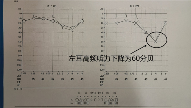 邹先生的左耳高频听力为60分贝(正常值应低于25分贝,属于重度耳聋