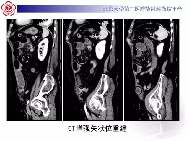 急诊你一定要知道的"半月线疝"