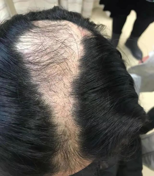 9岁女孩突然秃了,查明原因后,父母后悔不已!掉头发数