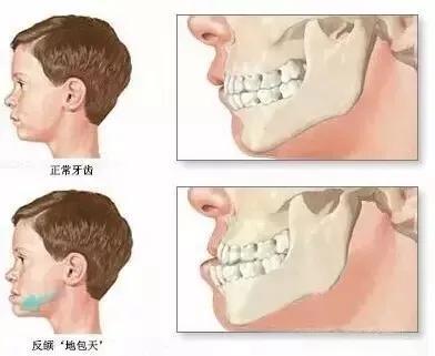 (病例图片转自网络 偏侧咀嚼:导致面部发育不对称.