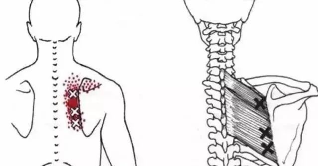 肩颈酸痛,是不是菱形肌作怪?