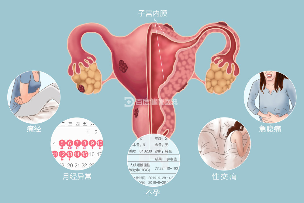 泸州锦欣妇科专家:流产要注意了!可能是子宫内膜异位