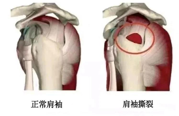 导致肩关节旋内,旋外和上举活动,且这些肌腱将肱骨头稳定于肩胛盂上