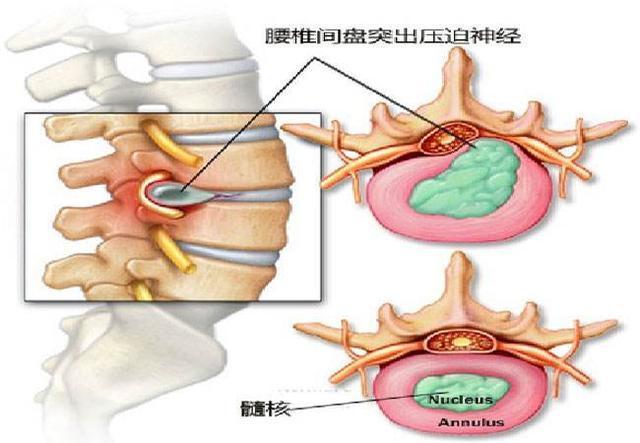 腰椎间盘突出青壮年好发