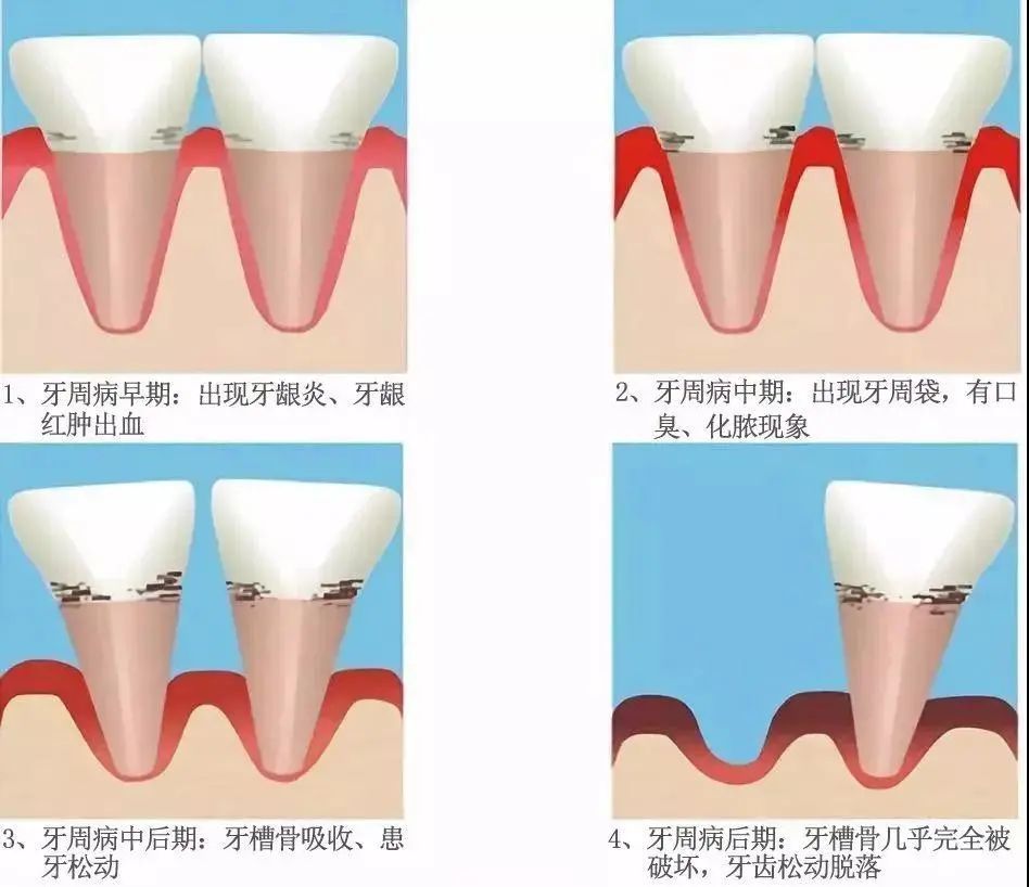 【天天健康】牙齿松动,牙龈出血,肿胀怎么办?