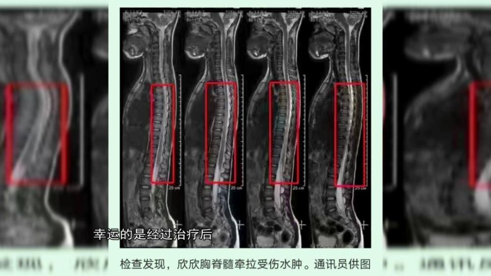 9岁女孩因一个动作,致下肢瘫痪,大小便失禁!