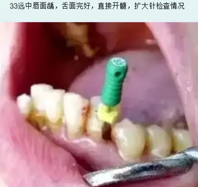 根管治疗的一个重要步骤:开髓术