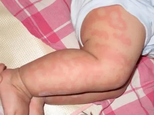 1,小儿荨麻疹的症状之急性荨麻疹