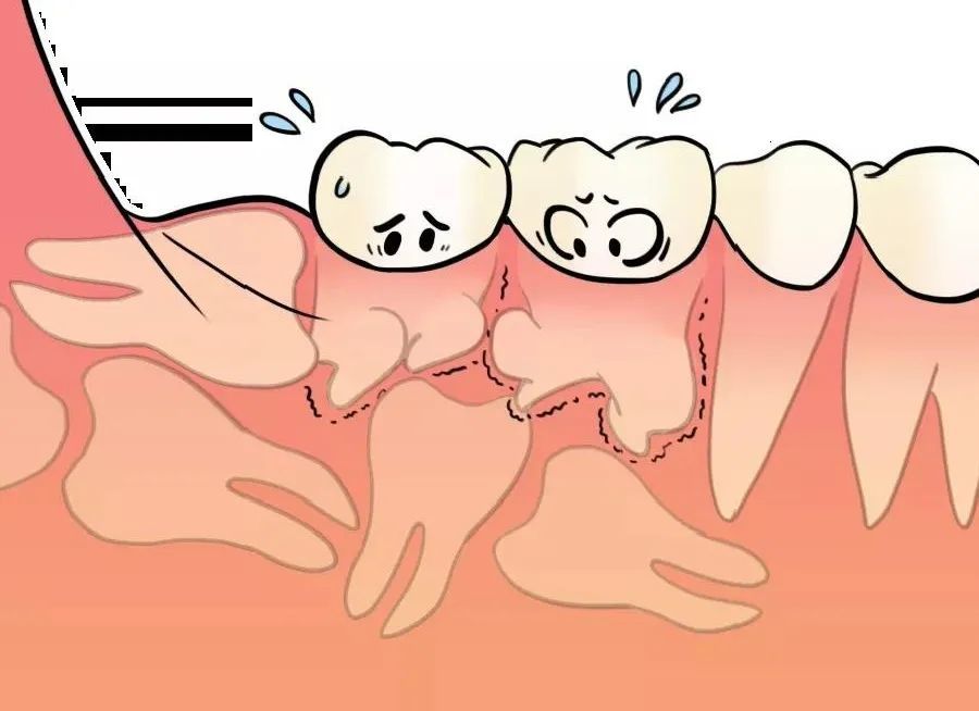 智齿是指人类口腔内牙槽骨上最里面的第三颗磨牙,是口腔中 最晚长出