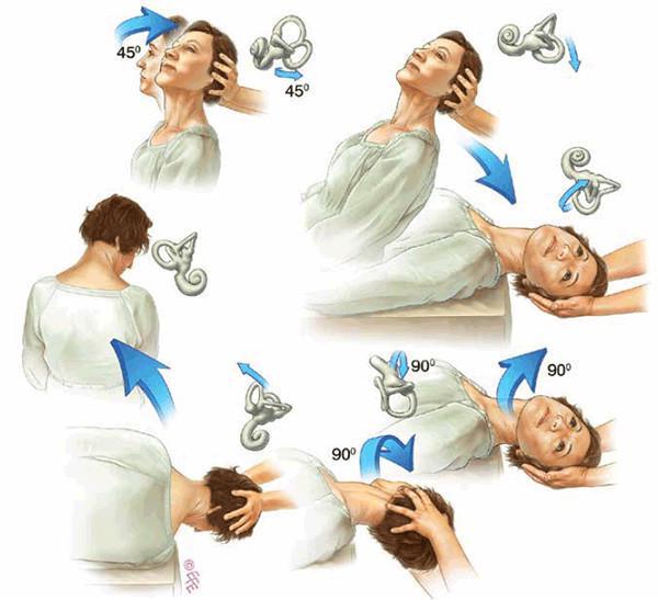 图5 bppv的epley"s复位手法.图片引自alliedhealth.net.au