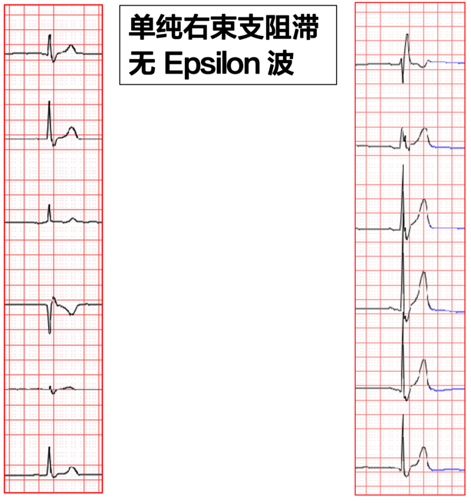 epsilon 波的识别及临床意义|同济专栏