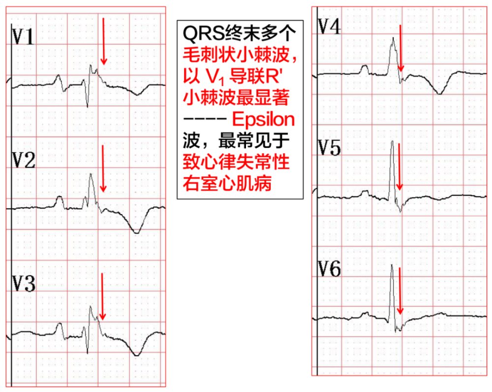 epsilon 波的识别及临床意义|同济专栏