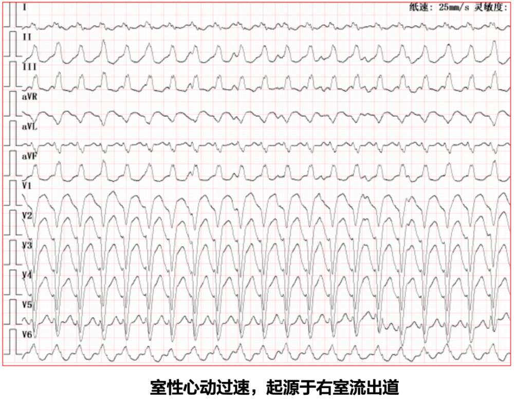 epsilon 波的识别及临床意义|同济专栏