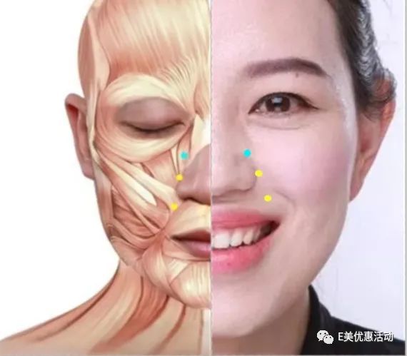 高阶注射方法——注射在上唇鼻翼提肌,颧大/小肌 不仅能解决露龈笑