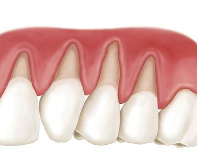 滋生刺激所致;另外,随着年龄的增长也会或多或少出现萎缩,使牙根暴露