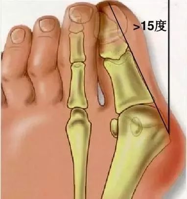 女性注意爱穿高跟鞋脚趾竟然长这样了