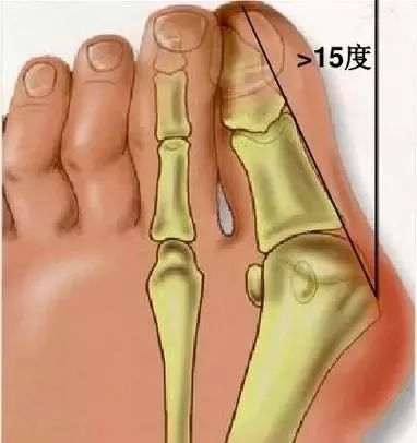 畸形和疼痛都会逐渐加重,严重的还会影响到其他脚趾及关节的位置