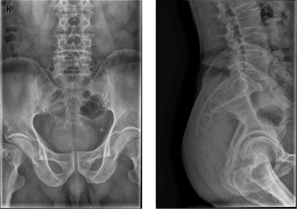 case7:m,62y;8月前前列腺手术发现骶尾部肿物,无不适,现肿物逐渐增大