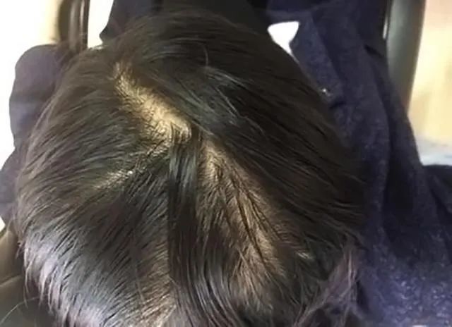 脂溢性脱发怎么治好?换发新生,重新乌黑浓密!
