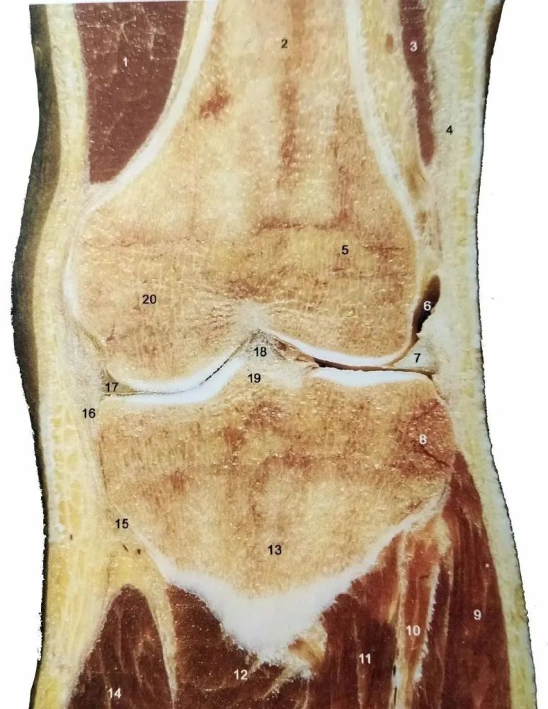 膝关节冠状断层 经胫骨髁间隆起和前交叉韧带的冠状断层
