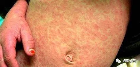 或猩红热样(图6)皮疹