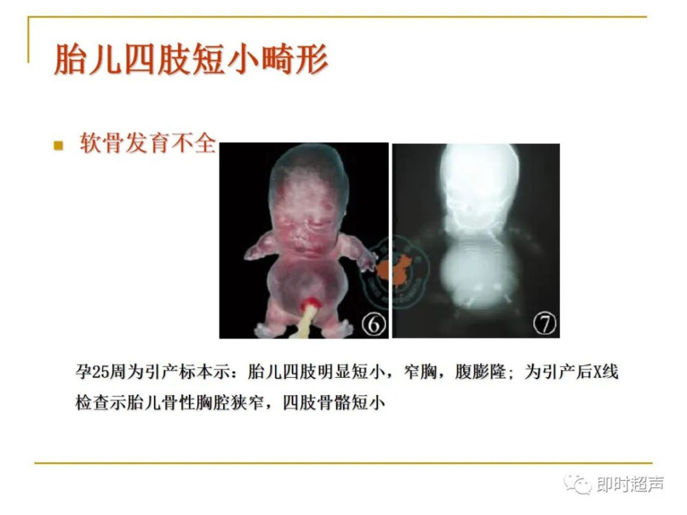 胎儿先天性手足畸形 手足部形态结构或数目异常畸形,先天性手足部