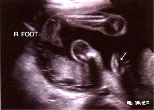 胎儿肢体畸形超声图表现如何解读和诊断早发现早处理