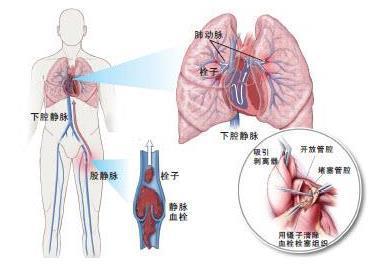 每天久坐可能导致肺动脉栓塞,这个坏习惯,很多人都有